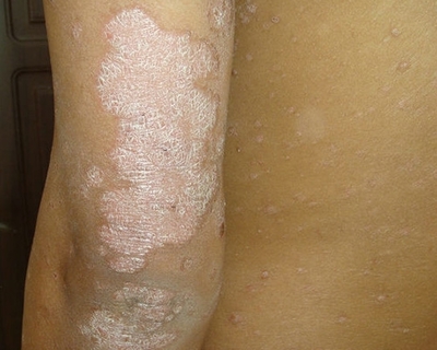 河南哪家醫院牛皮癬治的好?牛皮癬一定不能吃辣椒嗎?