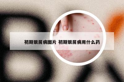 初期銀屑病圖片 初期銀屑病用什么藥