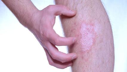 蜂產(chǎn)品治療牛皮癬