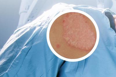 銀屑病智能化產品