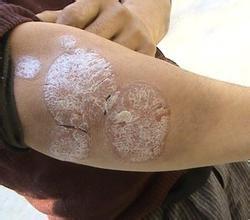 長(zhǎng)春治療牛皮癬的醫(yī)院有哪些