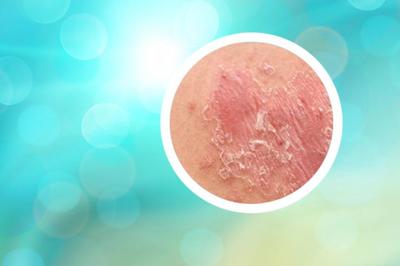 小孩起牛皮癬抹什么藥