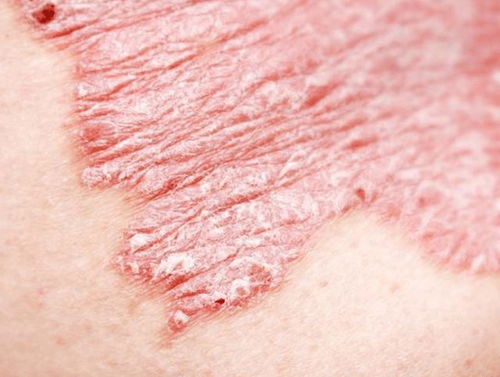 幾塊錢一瓶的甲硝唑,或能幫助擺平這4種病,你知道嗎