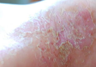 白酒泡花椒治牛皮癬嗎