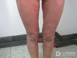 牛皮癬要怎么正確防護