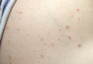 點滴狀副牛皮癬的特點介紹