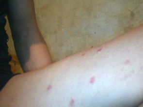 使用牛皮癬軟膏應該注意哪些