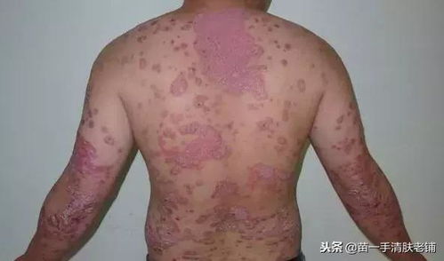 患了牛皮癬 吃這個食品,對牛皮癬的康復很有幫助