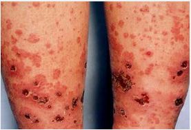 牛皮癬性血管炎癥狀