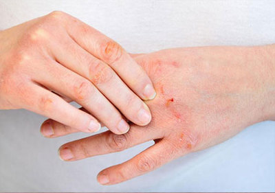 手足牛皮癬癥狀圖片是什么樣的及治療