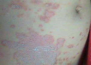 關于牛皮癬傳染孕婦