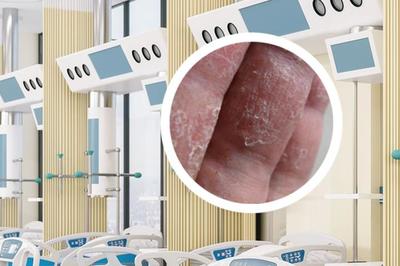 銀屑病的正規治療方法