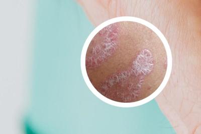 偏方根治銀屑病