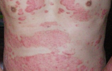 男性紅皮病型牛皮癬表現