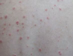 牛皮癬發作前兆是什么