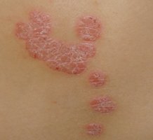 遺傳引發牛皮癬嗎