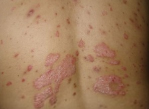 牛皮癬引起原因有哪些