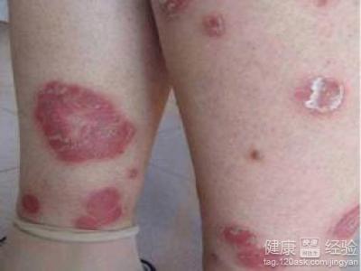 白疵就是牛皮癬嗎