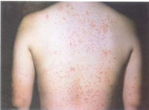 牛皮癬是什么樣的