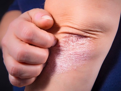 牛皮癬的飲食禁忌