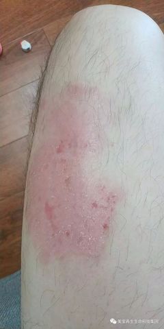 牛皮癬患者遇上美寶,從此不再痛苦煩惱