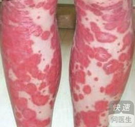 牛皮癬的飲食要注意什么