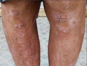 難治的牛皮癬,靠吃就能痊愈