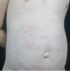 生物制劑治療銀屑病 司庫奇優(yōu)單抗 蘇金 阿達(dá)木單抗 烏斯奴單抗 牛皮癬 生物治療