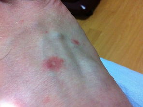 請看看是不玫瑰糠疹還是銀屑病,或者同時(shí)都有 怎么腳上的這么嚴(yán)重