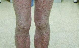 關(guān)節(jié)型牛皮癬癥狀