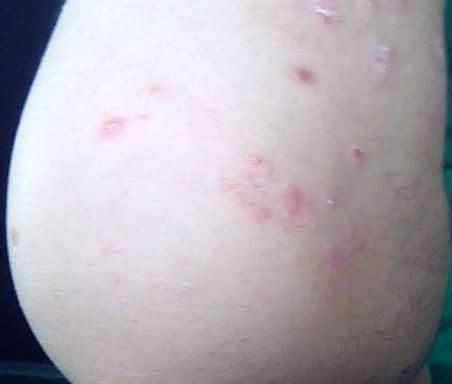牛皮癬的早期癥狀圖片