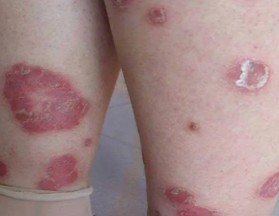 身患牛皮癬,該注意什么避免復(fù)發(fā)?