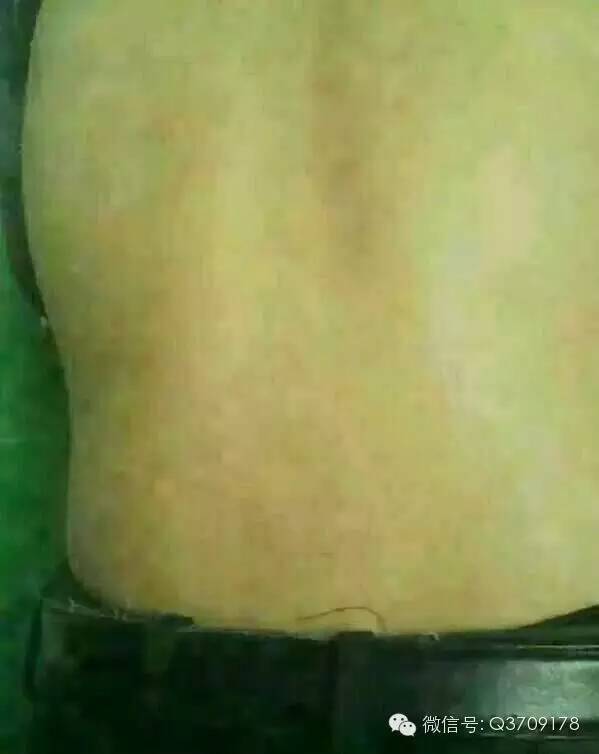 健康在轉(zhuǎn)彎處等著您 完美產(chǎn)品見證 多年頑固的牛皮癬看不好,完美產(chǎn)品出奇效 超贊