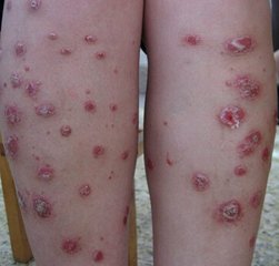 少年銀屑病壽命會(huì)有影響嗎