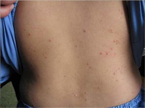 中醫(yī)解讀牛皮癬發(fā)病機(jī)理