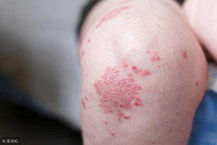 正確認(rèn)識(shí)銀屑病,避免步入下面五個(gè)誤區(qū)