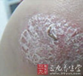 牛皮癬患者不能吃哪些食物