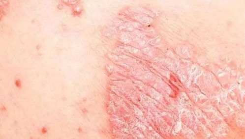 水果不自由 那么牛皮癬 濕疹和蕁麻疹三大皮膚病該如何吃水果