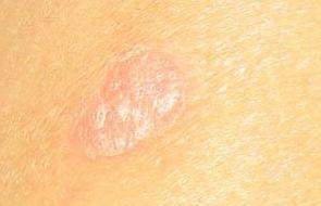 季節(jié)性牛皮癬復(fù)發(fā)前一般都會(huì)出現(xiàn)哪些癥狀表現(xiàn)呢