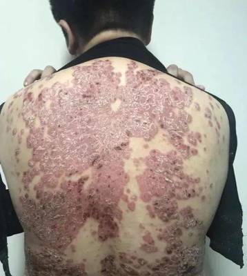 【科普】&ldquo;頑疾&rdquo;銀屑病會(huì)傳染嗎?如何治療?市一醫(yī)院皮膚科專家?guī)阕哌M(jìn)治療新時(shí)代