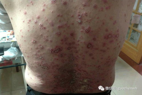 國(guó)珍產(chǎn)品調(diào)理好了老爸26年牛皮癬,食道靜脈曲張等疾病,感恩國(guó)珍