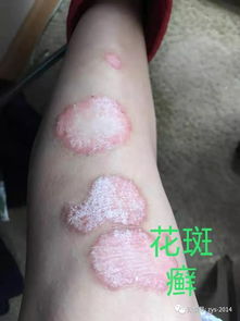 皮膚頑疾為什么好的那么快,原來(lái)秘密在這