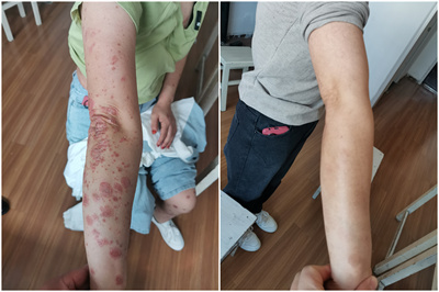 牛皮癬##銀屑病# 根治銀屑癬評(píng)論區(qū)聯(lián)系,銀屑病是一種慢性,復(fù)發(fā)性