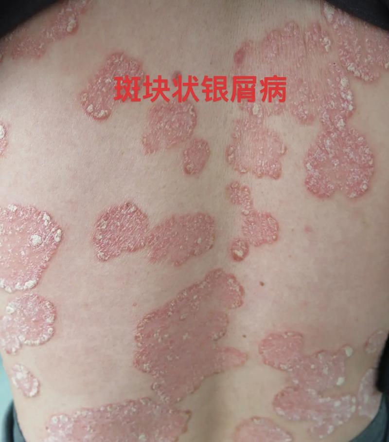 銀屑病,俗稱牛皮癬,為皮膚科常見(jiàn)病.但有的患者不熟悉,不了解