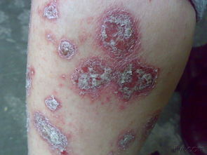 經典圖片 銀屑病