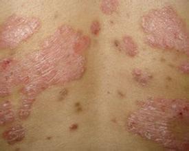 銀屑病治療要注意哪幾點