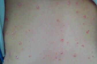 紅皮型牛皮癬初期會有哪些具體表現(xiàn)