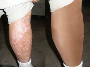 皮膚癢,還反復(fù) 牛皮癬 銀屑病 你還想忍多久