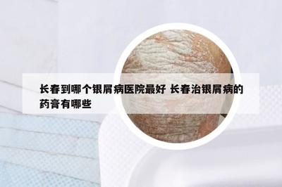 長春到哪個(gè)銀屑病醫(yī)院最好 長春治銀屑病的藥膏有哪些