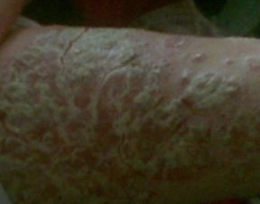 牛皮癬患者吃的水果